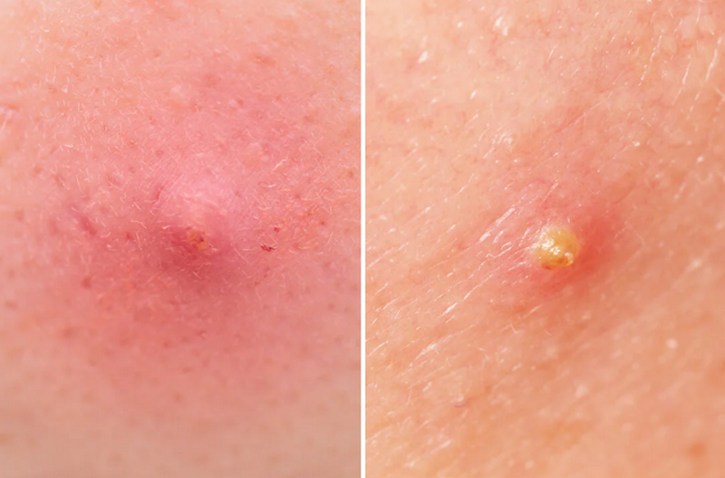 Mụn mủ là gì? Cách điều trị mụn mủ hiệu quả