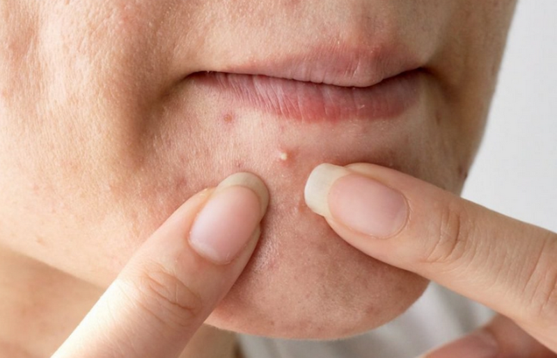 Các loại mụn trứng cá thường gặp và cách phân biệt