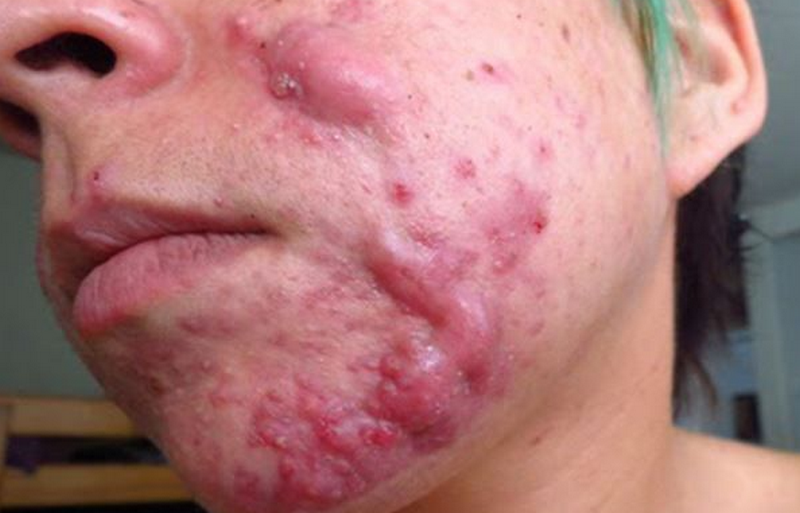 Các loại mụn trứng cá thường gặp và cách phân biệt