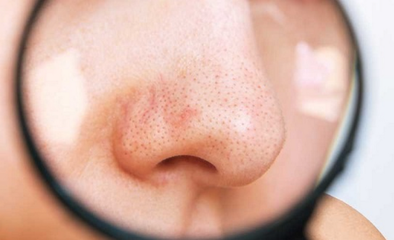 Các loại mụn trứng cá thường gặp và cách phân biệt