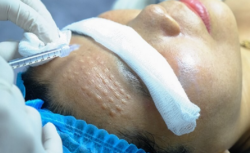 Tiêm meso phục hồi da an toàn và hiệu quả