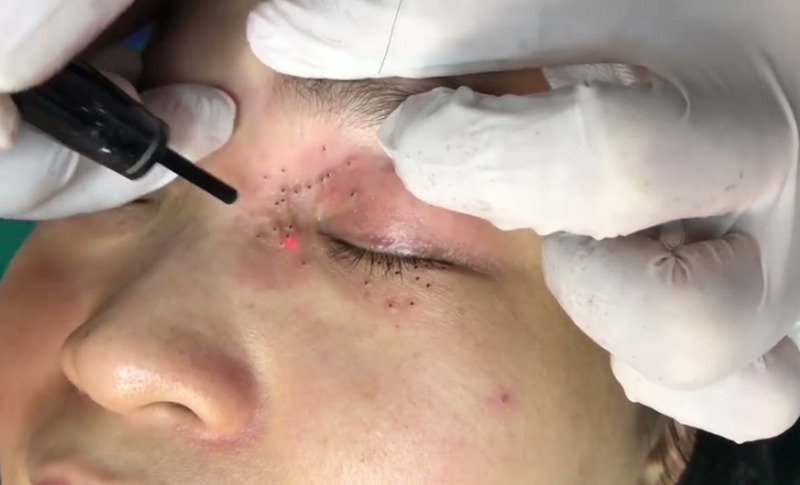 Mụn gạo là gì? Nguyên nhân, cách điều trị và phòng ngừa hiệu quả