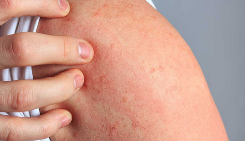 Nguyên nhân ngứa toàn thân vào ban đêm và giải pháp khắc phục