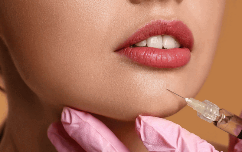 Tiêm filler cằm bao lâu thì vào form, giữ được trong bao lâu?