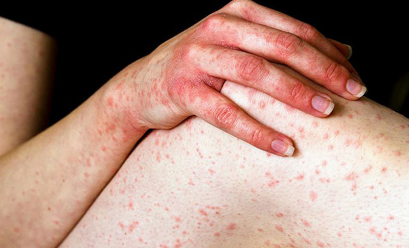 Bị ngứa khắp người không rõ nguyên nhân và giải pháp điều trị