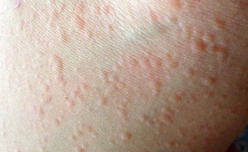 Ngứa châm chích toàn thân vào ban đêm và các bệnh liên quan