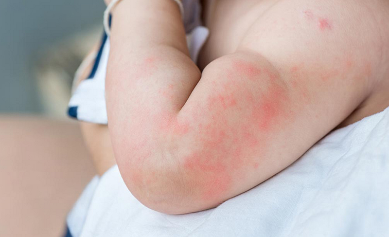 Ngứa châm chích toàn thân vào ban đêm và các bệnh liên quan