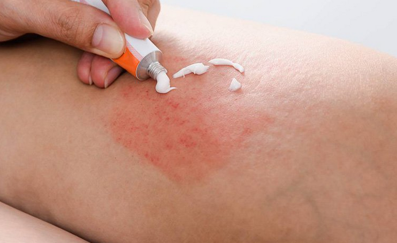 Da nổi mẩn đỏ ngứa như muỗi đốt cảnh báo điều gì? Cách điều trị hiệu quả