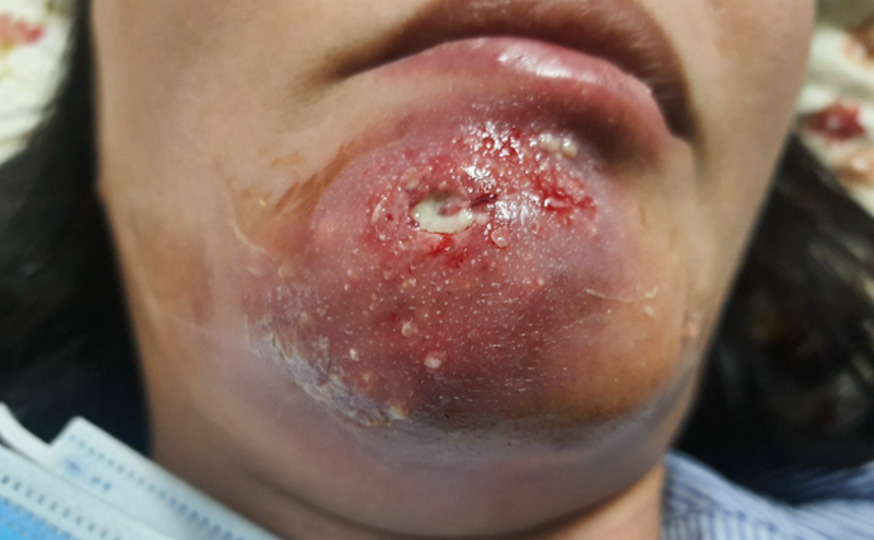 Có nên nặn mủ vết thương không? Cách xử lý an toàn và hiệu quả