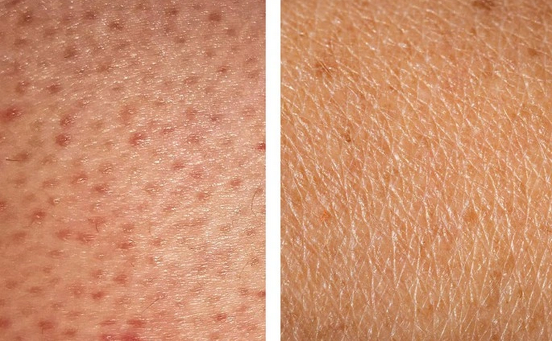 Viêm nang lông có tự hết không, cách điều trị an toàn và hiệu quả