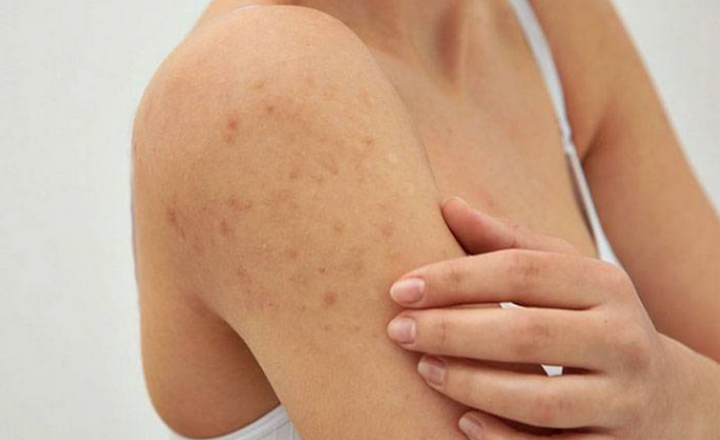 Viêm nang lông có tự hết không, cách điều trị an toàn và hiệu quả