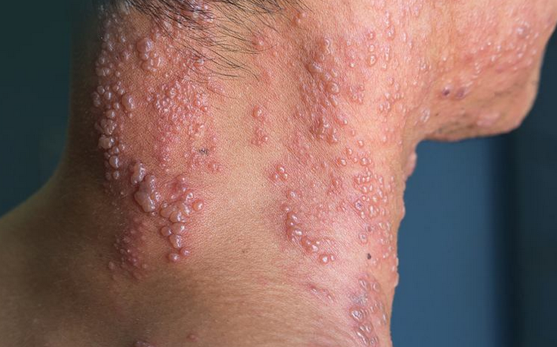 Viêm da nhiễm trùng là gì? Các dạng bệnh thường gặp