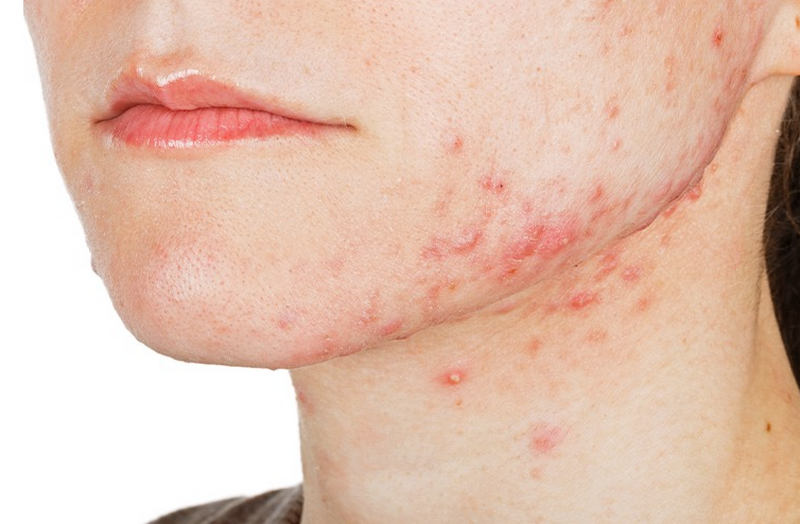 Uống gì để trị mụn nội tiết nhanh chóng và an toàn