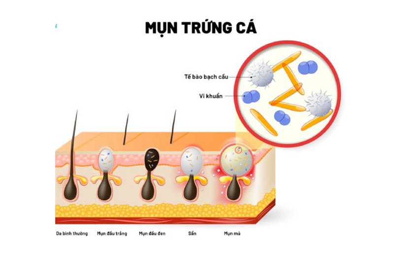 Cách lựa chọn sản phẩm trị mụn trứng cá