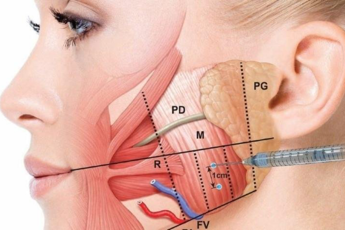 Tiêm botox gọn hàm đòi hỏi bác sĩ có trình độ chuyên môn với độ chính xác cao