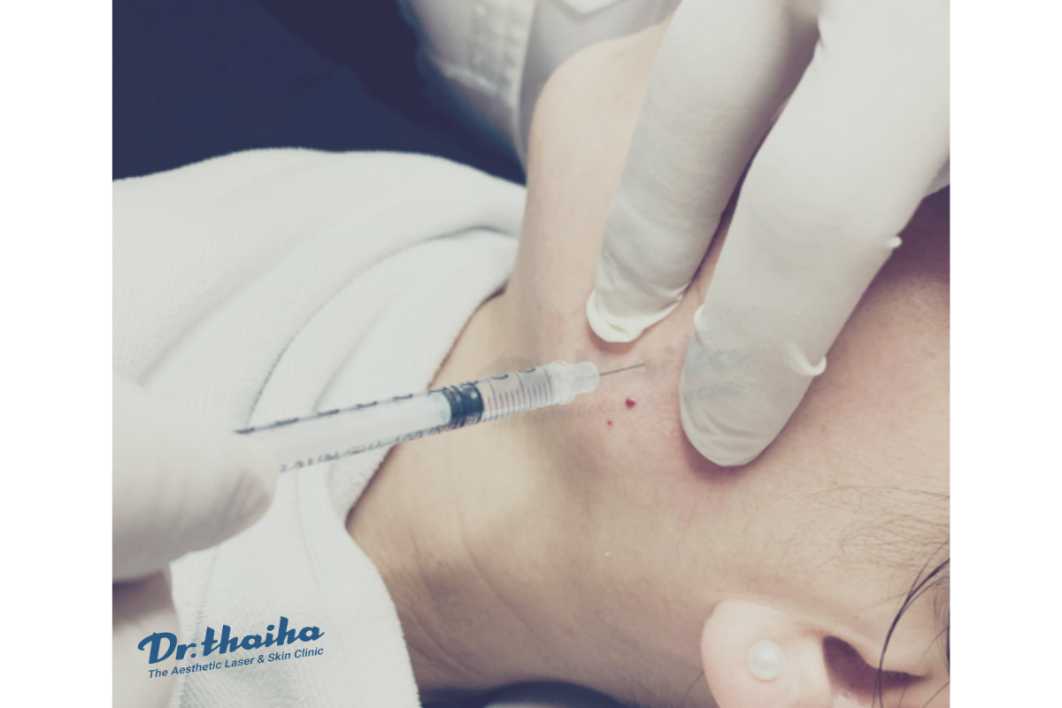 Tiêm botox gọn hàm tại Phòng khám Da liễu Thẩm mỹ Thái Hà