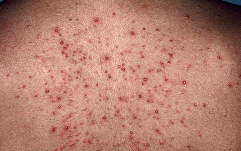 Viêm nang lông là gì? Cách điều trị hiệu quả