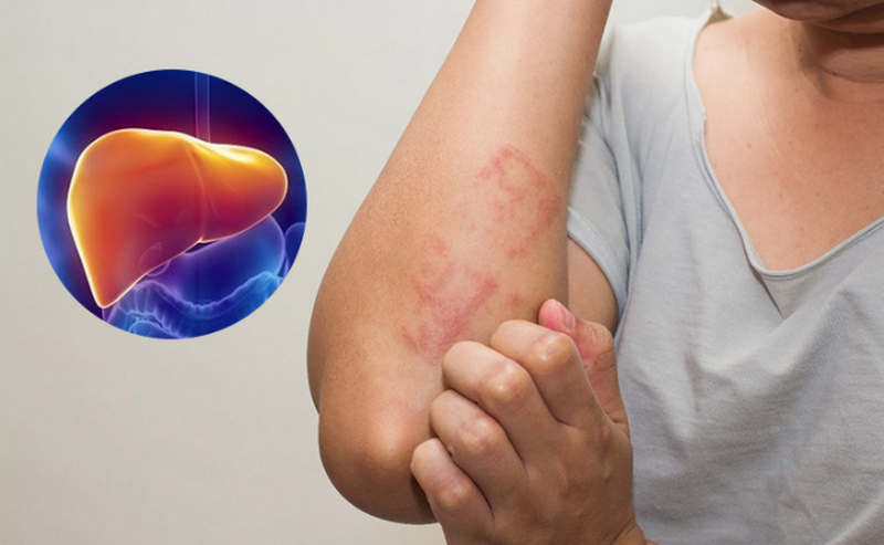 Nóng gan nổi mẩn ngứa phải làm sao? 