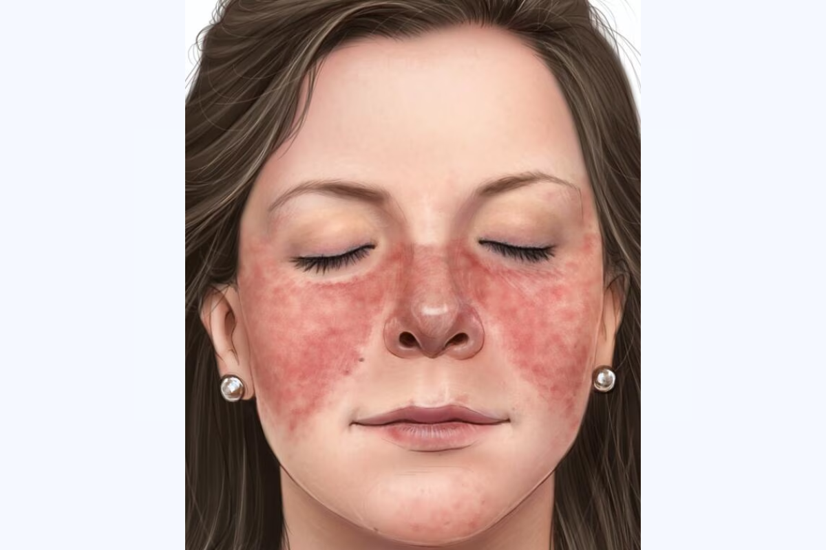 Phát ban hình cánh bướm trên da mặt là dấu hiệu điển hình lupus ban đỏ hệ thống