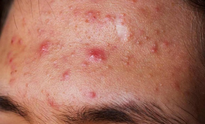 Hiện tượng sau khi peel da và cách phục hồi hiệu quả