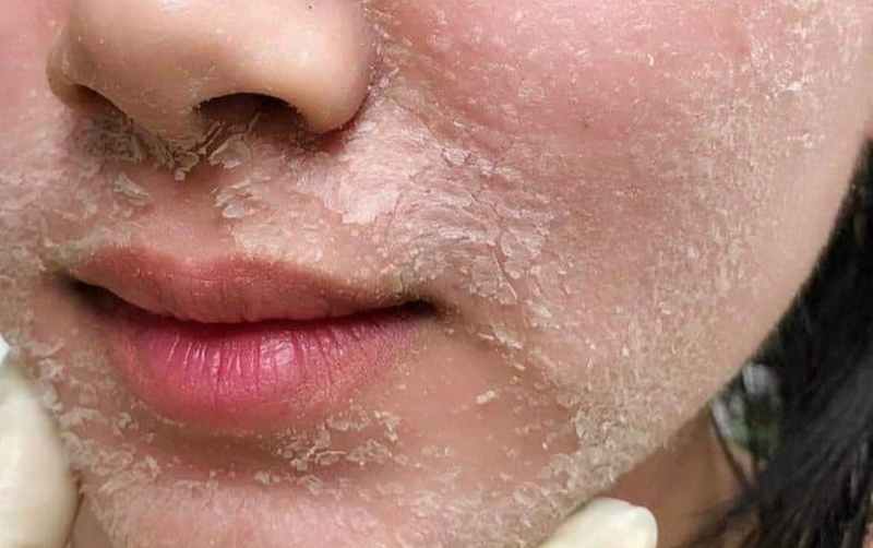 Hiện tượng sau khi peel da và cách phục hồi hiệu quả