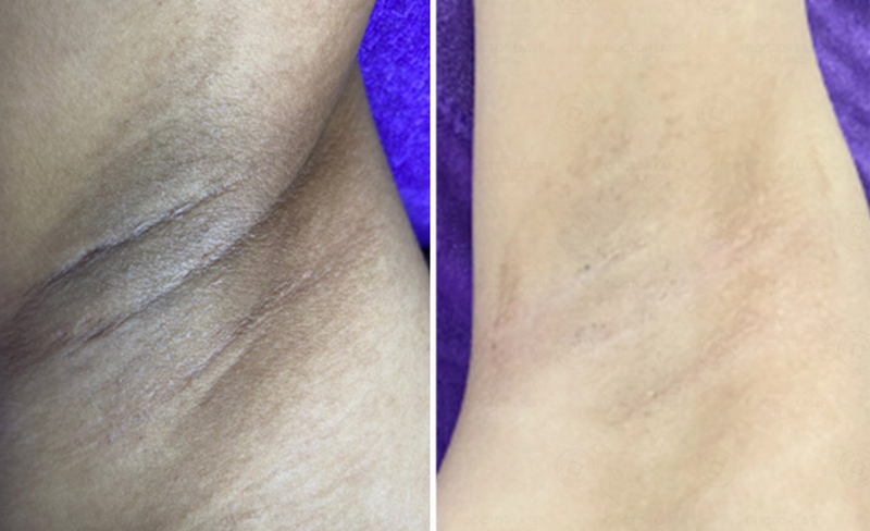 Peel nách là gì? Peel da trị thâm nách được không?