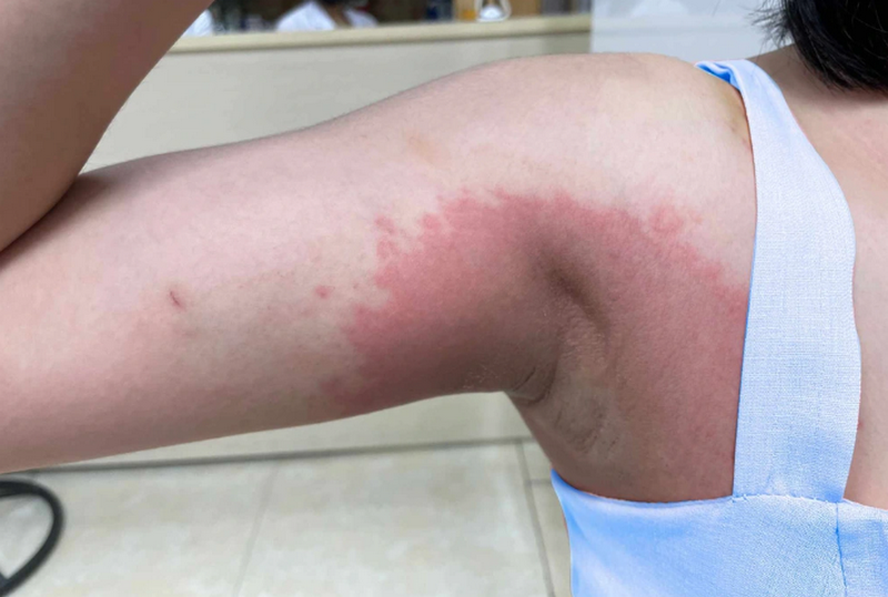 Peel nách là gì? Peel da trị thâm nách được không?