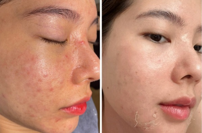 Peel da sinh học và những gì bạn cần biết