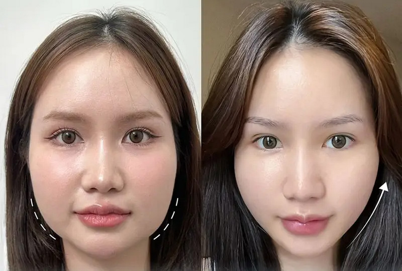 Tiêm botox gọn hàm giữ được bao lâu? Lưu ý cần thiết