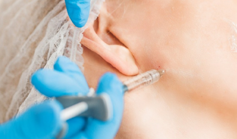 Tiêm botox gọn hàm giá bao nhiêu tiền, tiêm ở đâu tốt?
