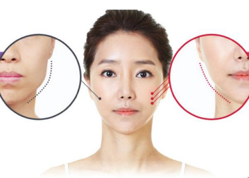 Tiêm botox gọn hàm giá bao nhiêu tiền, tiêm ở đâu tốt?
