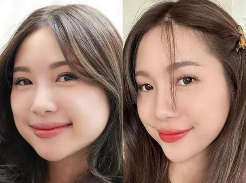 Biểu hiện sau khi tiêm botox gọn hàm và những điều bạn cần biết