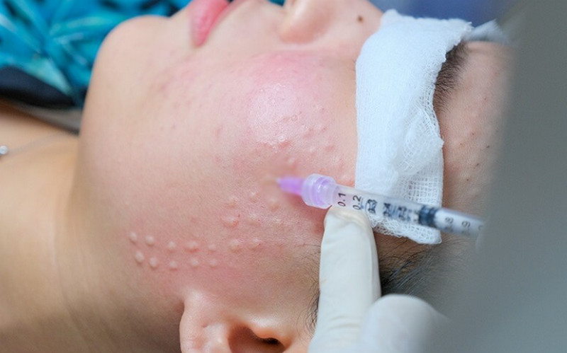 Tác hại của tiêm meso và cách phòng tránh an toàn