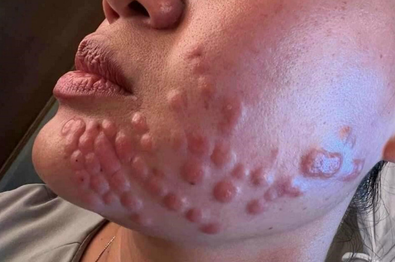 Tác hại của tiêm meso, biến chứng và cách phòng tránh an toàn