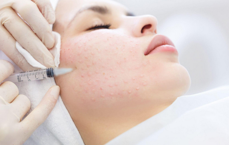 Fusion Meso: Giải pháp Mesotherapy thế hệ mới