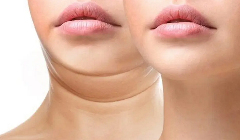 Tiêm tan mỡ nọng cằm có hiệu quả? Ưu nhược điểm so với hút mỡ cằm?