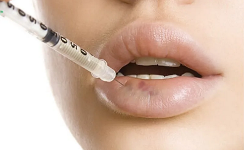 Tiêm tan filler bao lâu thì hết sưng? 5 cách giảm sưng hiệu quả
