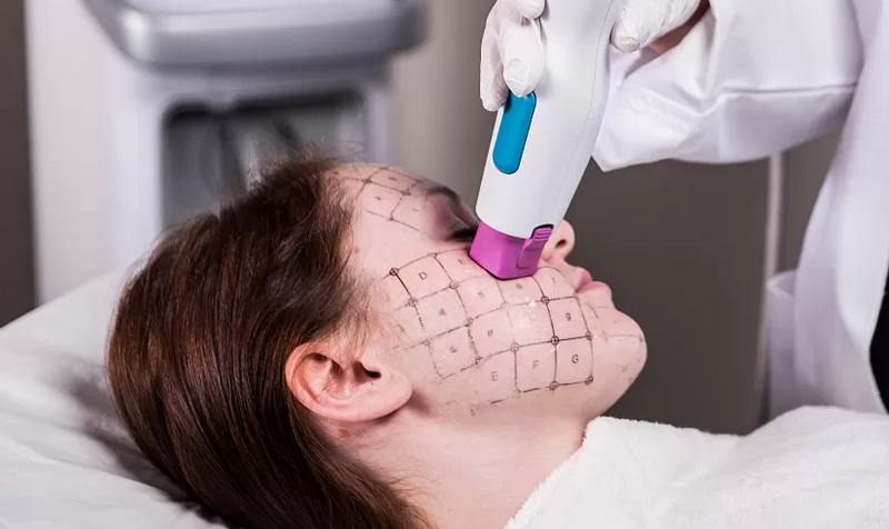 Nâng cơ trẻ hóa không phẫu thuật là gì? Các công nghệ phổ biến