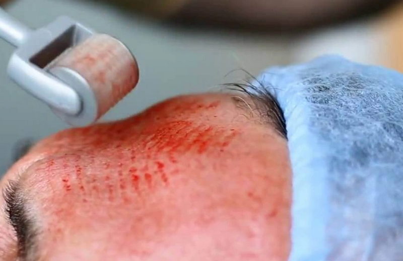 Lăn kim là gì? Quy trình và những lưu ý quan trọng
