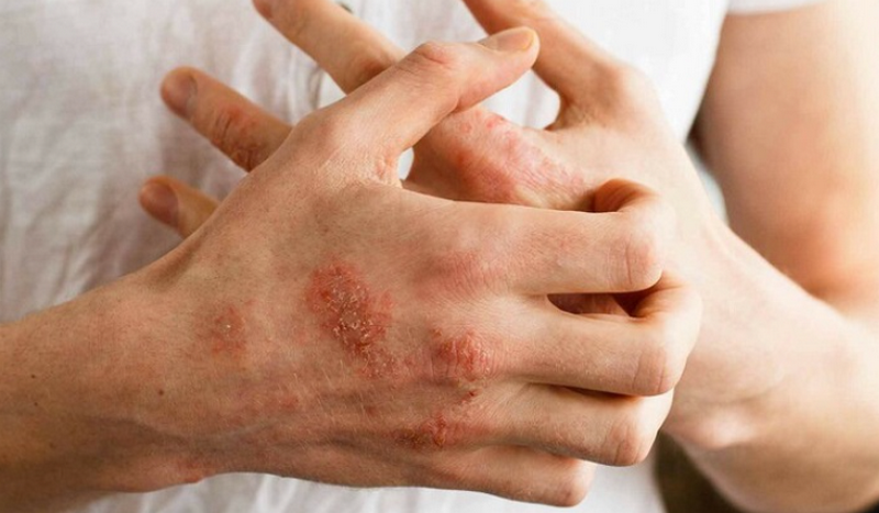Bị viêm da cơ địa là như thế nào? Bệnh có chữa được không?
