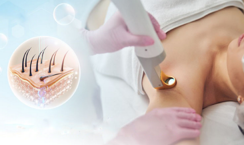 Triệt lông là gì? Có vĩnh viễn không? Cách triệt sạch lông an toàn