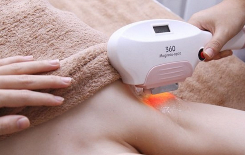 Triệt lông là gì? Có vĩnh viễn không? Cách triệt sạch lông an toàn