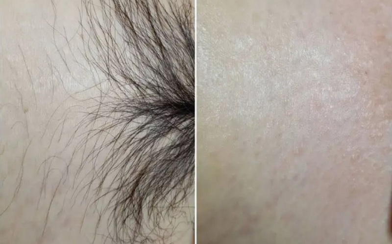 Triệt lông bikini và những điều bạn cần biết