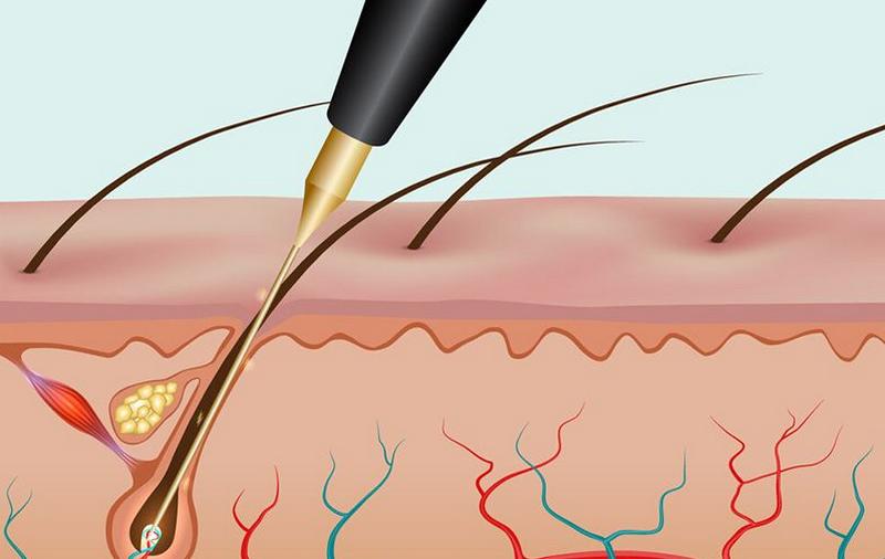 Triệt lông nách như thế nào? Giá bao nhiêu tiền