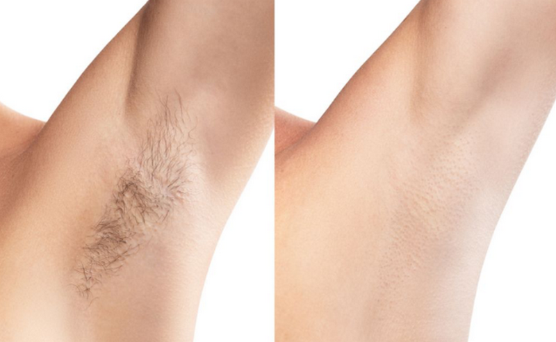 Triệt lông nách như thế nào? Giá bao nhiêu tiền