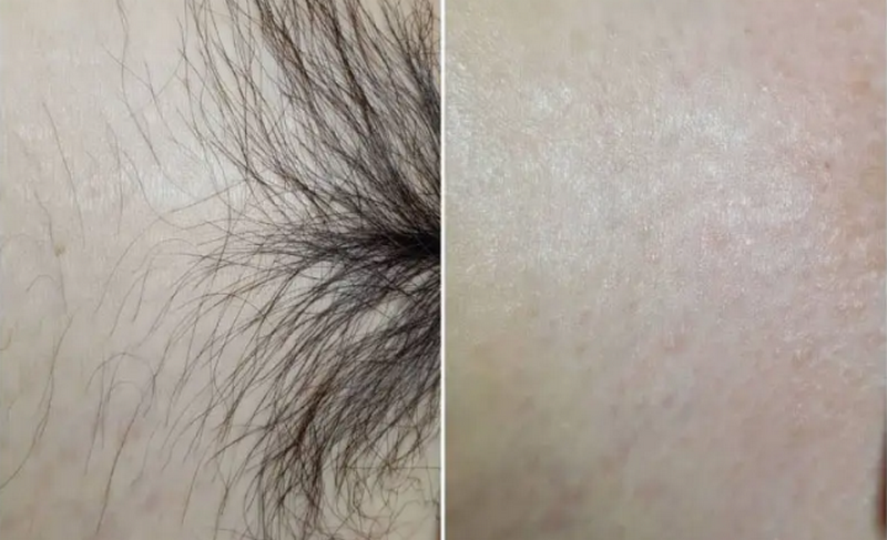 Tẩy lông vùng kín có tác dụng gì?