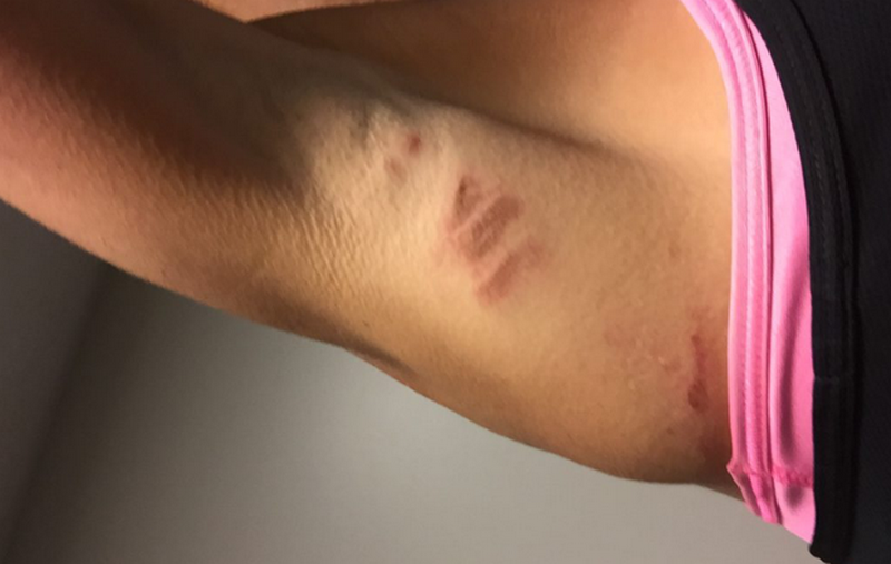 Triệt lông vĩnh viễn được không, giá triệt lông bao nhiêu tiền