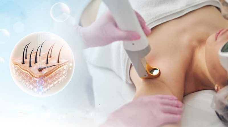 Spa triệt lông có tốt không? Cách chọn địa chỉ uy tín Hà Nội