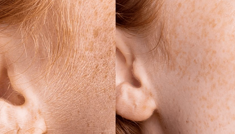 Có nên đến Spa triệt lông không? Địa chỉ uy tín tại Hà Nội