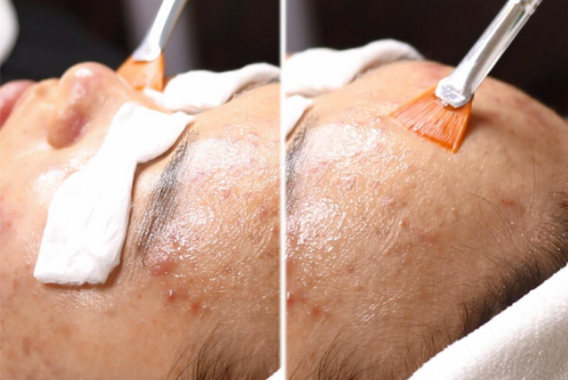 Tổng quan peel da trong trẻ hóa và điều trị da liễu